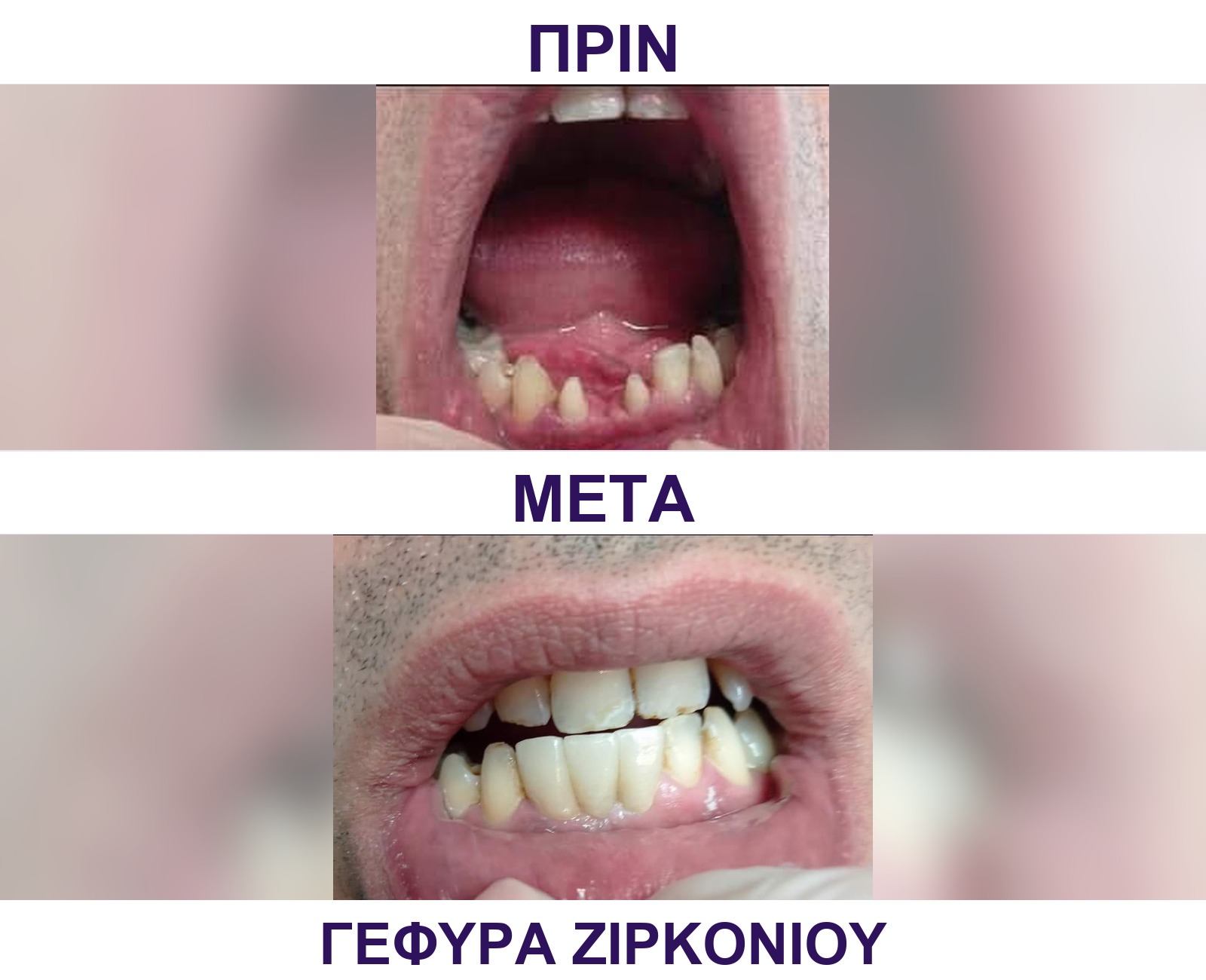 Γέφυρα ζιρκονίου — τρίτο περιστατικό πριν και μετά