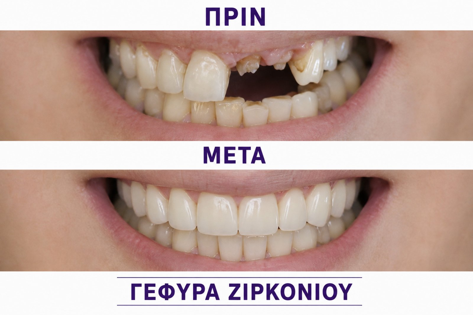 Γέφυρα ζιρκονίου — τέταρτο περιστατικό πριν και μετά