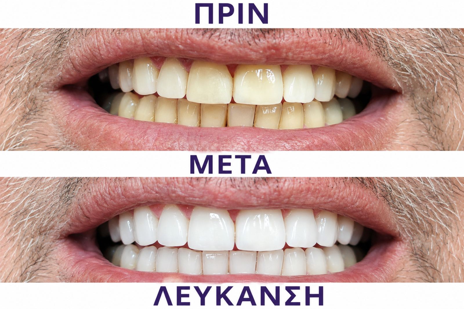 Λεύκανση δοντιών — δεύτερο περιστατικό πριν και μετά