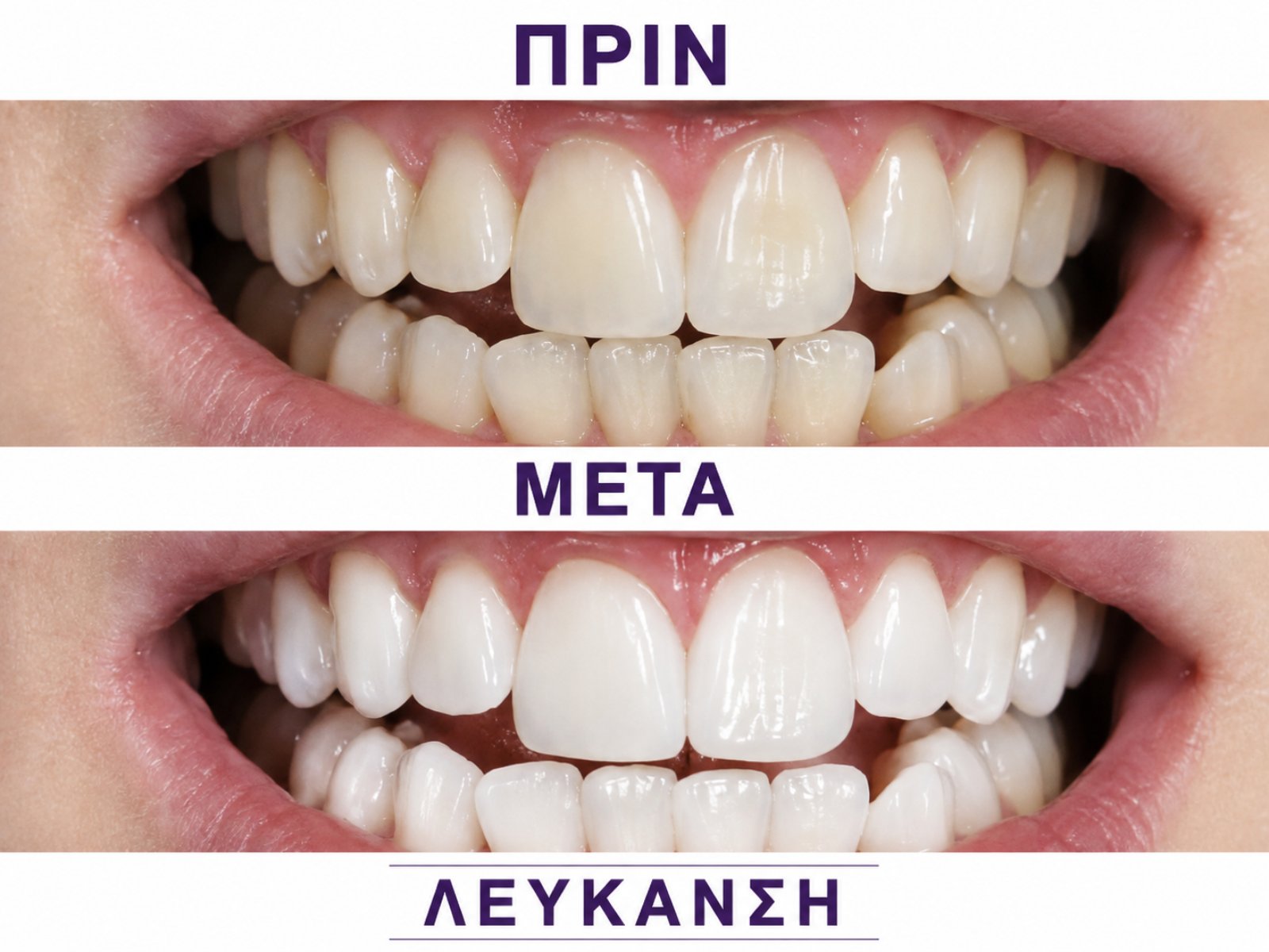 Λεύκανση δοντιών — τρίτο περιστατικό πριν και μετά
