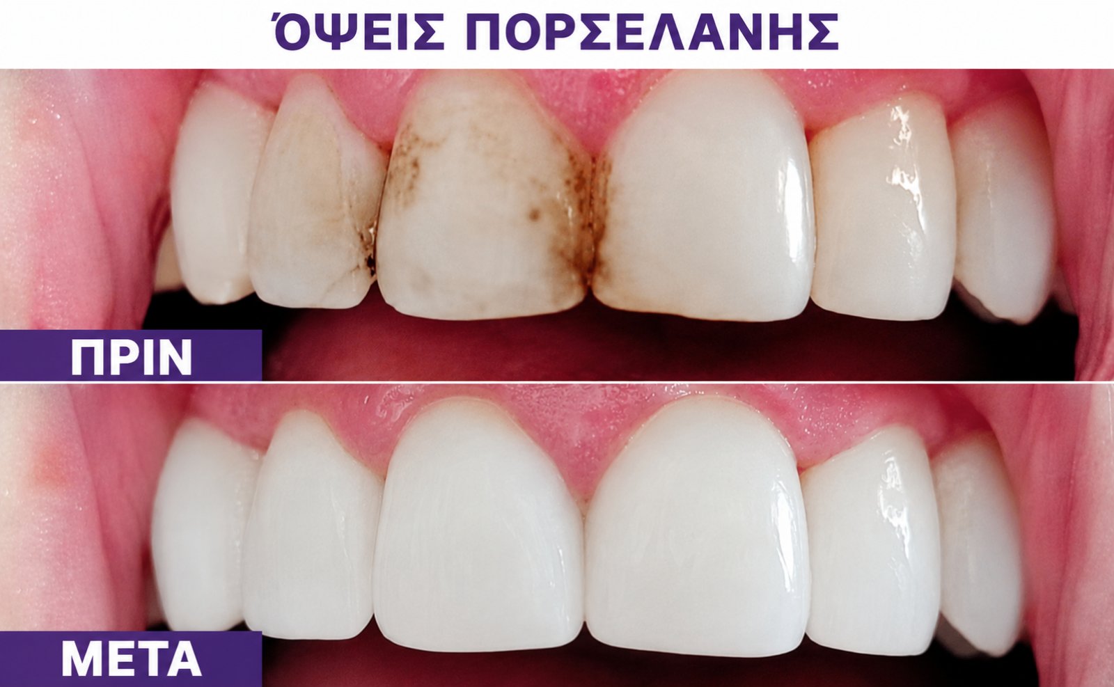 Όψεις πορσελάνης — δεύτερο περιστατικό πριν και μετά
